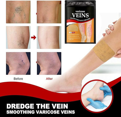 VariCose™ - Instant Relief Varicose Vein Patches (Pack of 12)