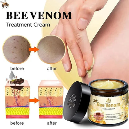 Bee Venom Vitigo Correcting Cream - (Pack of 2)