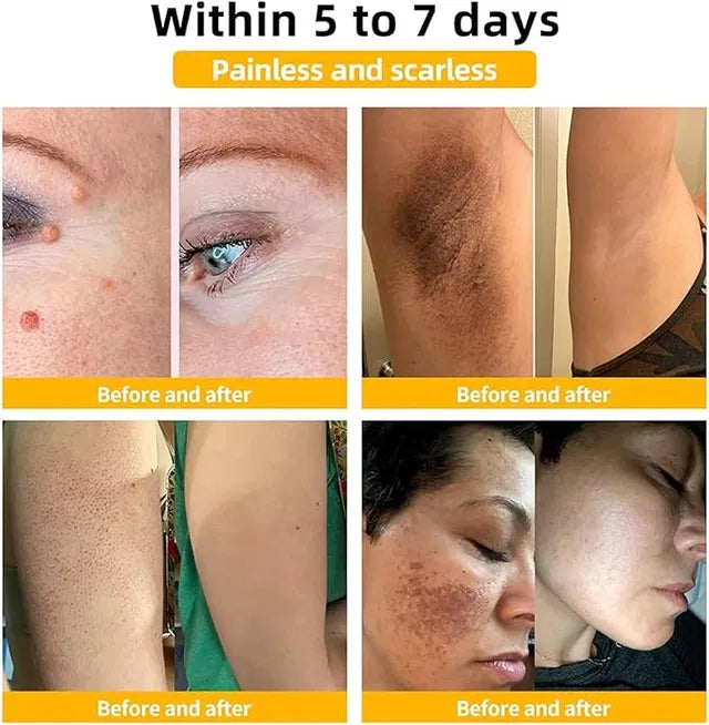 Bee Venom Vitigo Correcting Cream - (Pack of 2)